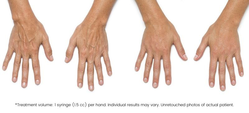 Radiesse hands before and after treatment by ABM Wellness in Goldsboro, NC.