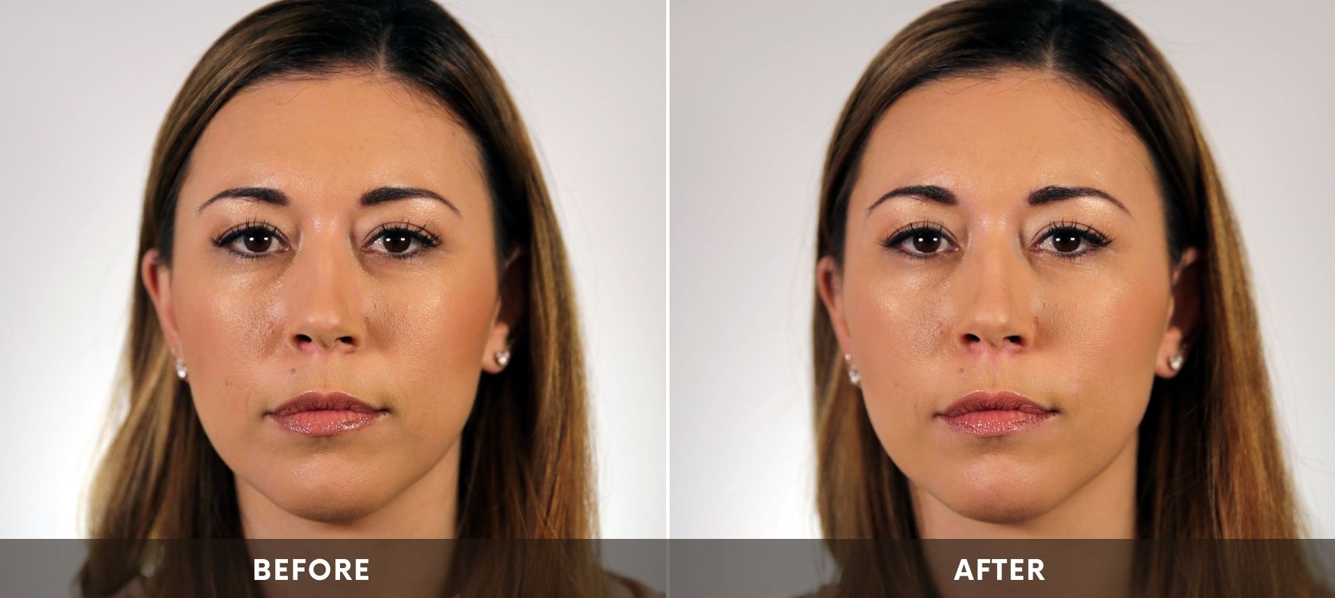 Womans face before and after Revanesse® Versa™ treatment at ABM Wellness in Goldsboro, NC.