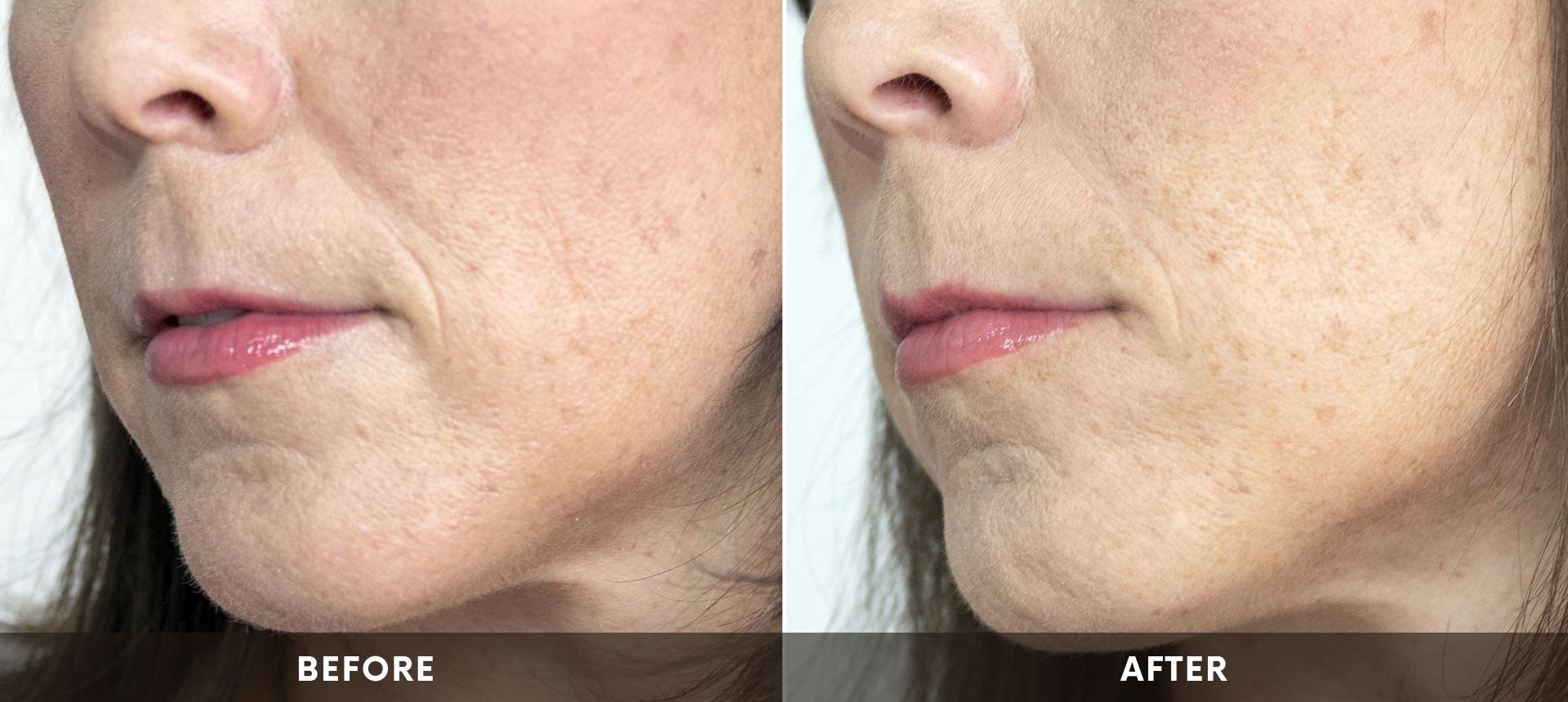 Womans face before and after Revanesse® Versa™ treatment at ABM Wellness in Goldsboro, NC.