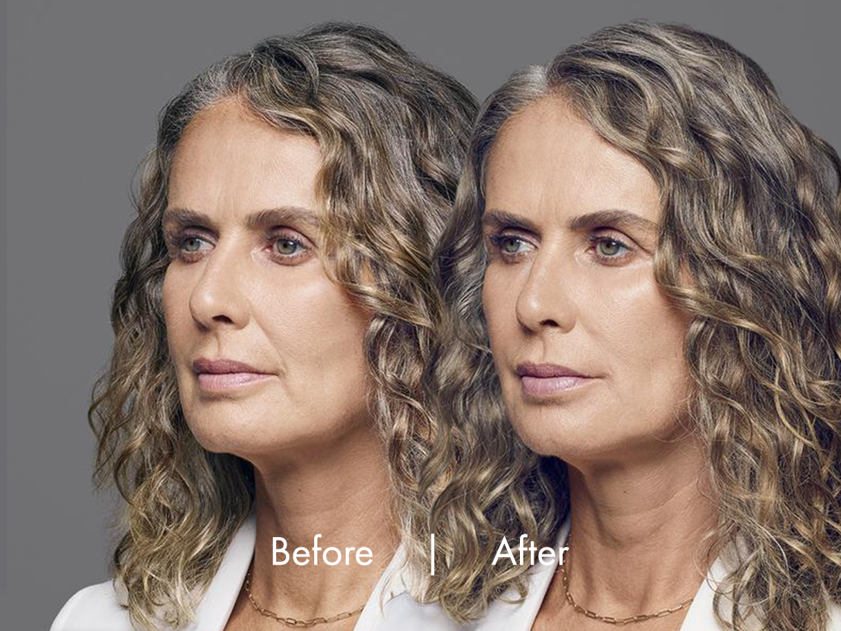 Womans RHA before and after dermal fillers treatment at ABM Wellness in Goldsboro, NC.