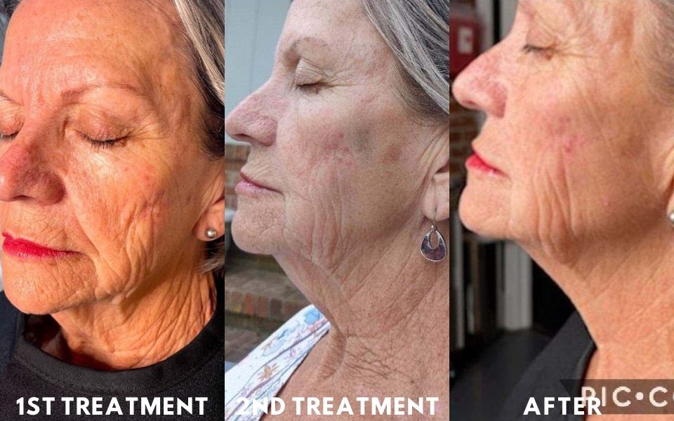 Woman's before and after microneedling treatment results in Goldsboro, NC at ABM Wellness.