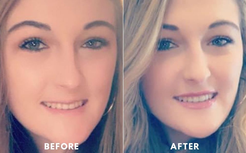 Womans RHA before and after dermal fillers treatment at ABM Wellness in Goldsboro, NC.