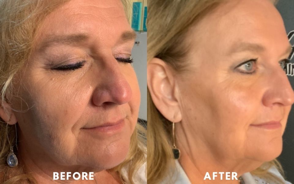 Woman's before and after Plasma facial treatment at ABM Wellness in Goldsboro, NC.